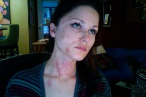 Anne-Christine Johnson with bruises